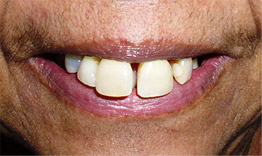 Dentures Before
